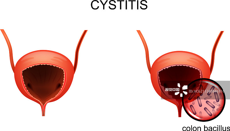 韓國首爾醫院公布：干細胞治療間質性膀胱炎的I期研究結果