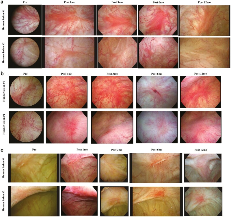 圖1：每位患者Hunner病變的連續膀胱鏡圖像。