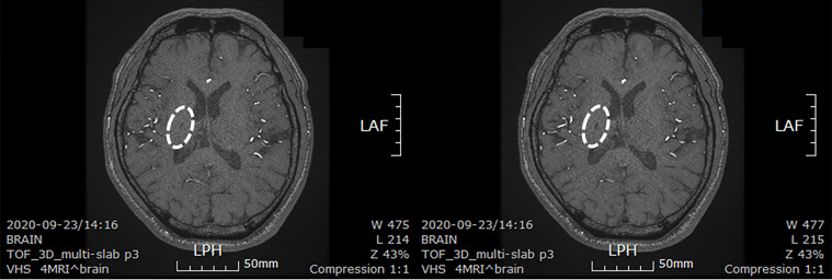 圖4：微創(chuàng)人臍帶間充質(zhì)干細(xì)胞移植后患者的腦部計(jì)算機(jī)斷層掃描圖像。