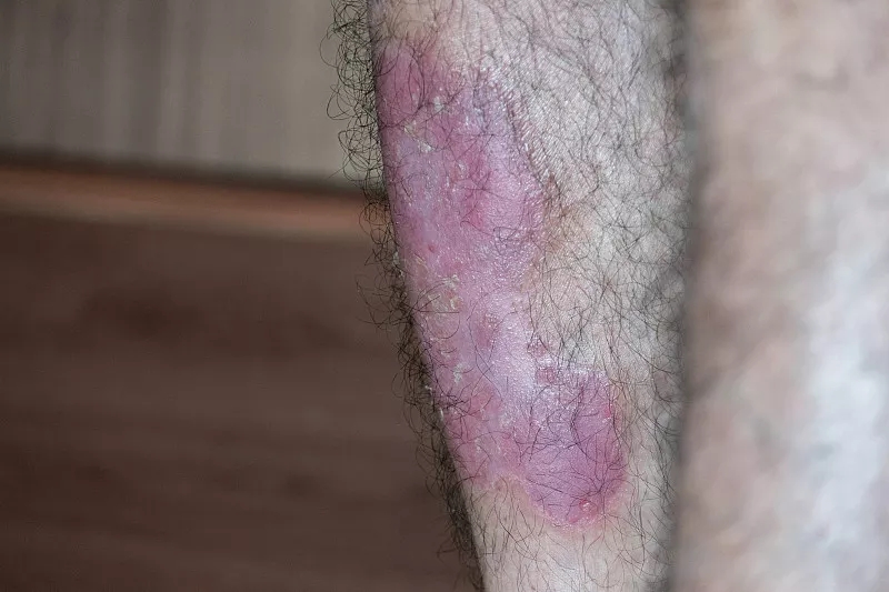 干細胞治療銀屑病