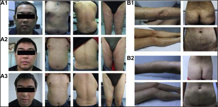 間充質干細胞治療銀屑病的臨床案例