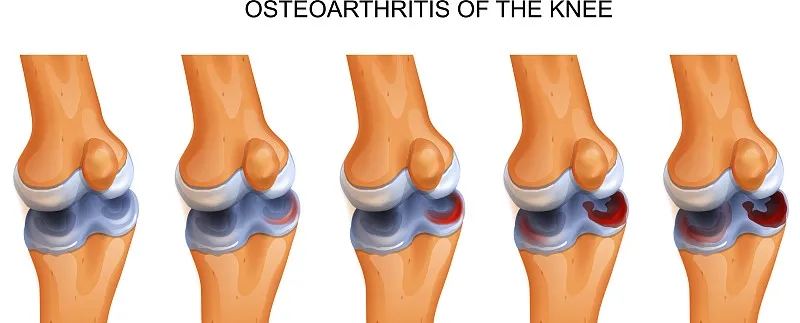 干細(xì)胞修復(fù)撕裂的無血管半月板軟骨：從體外優(yōu)化到首次人體研究