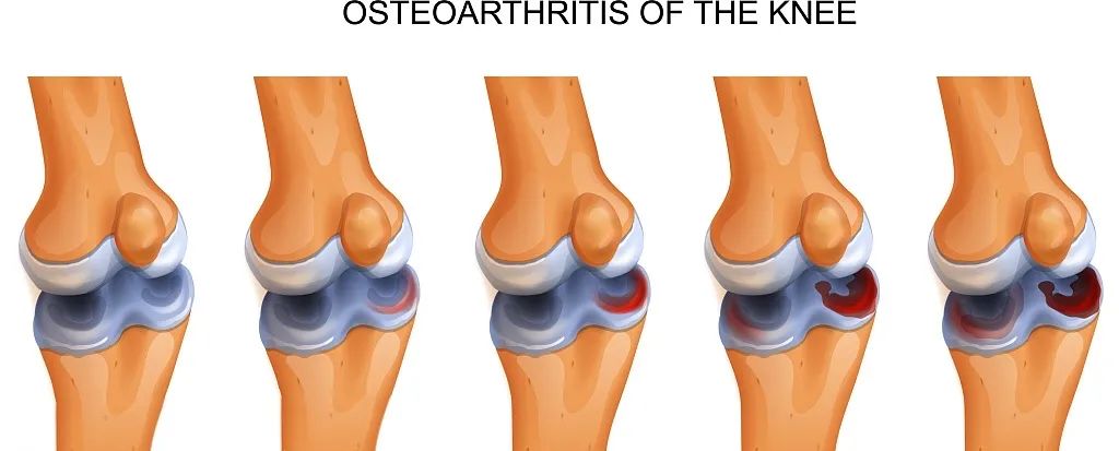 國內外臨床研究表明：干細胞修復半月板損傷更具優勢
