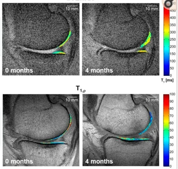 干細胞療法修復后疼痛顯著減輕，半月板軟骨質量提高。