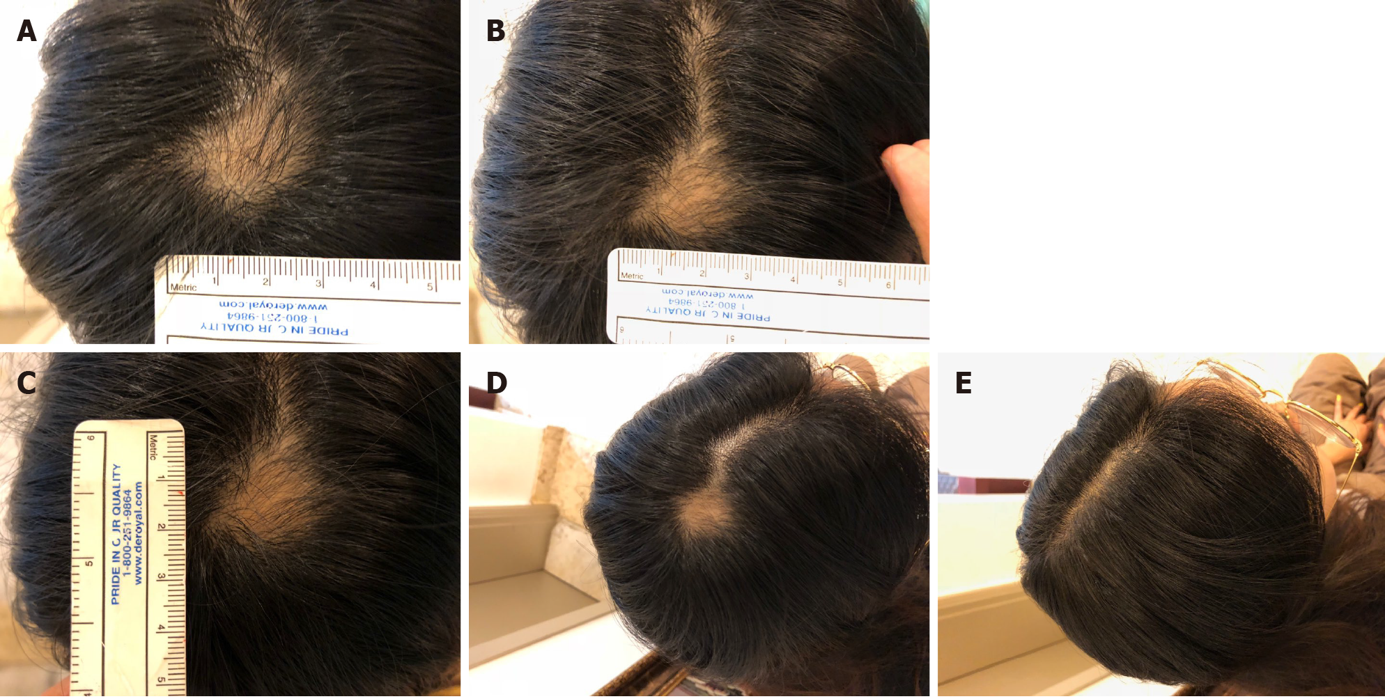 圖4：病例2治療期間和治療后病變部位可見變化。 