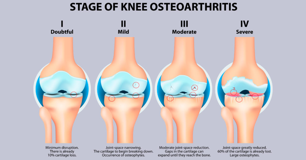骨關(guān)節(jié)炎癥狀有哪些 骨關(guān)節(jié)炎癥狀有哪些