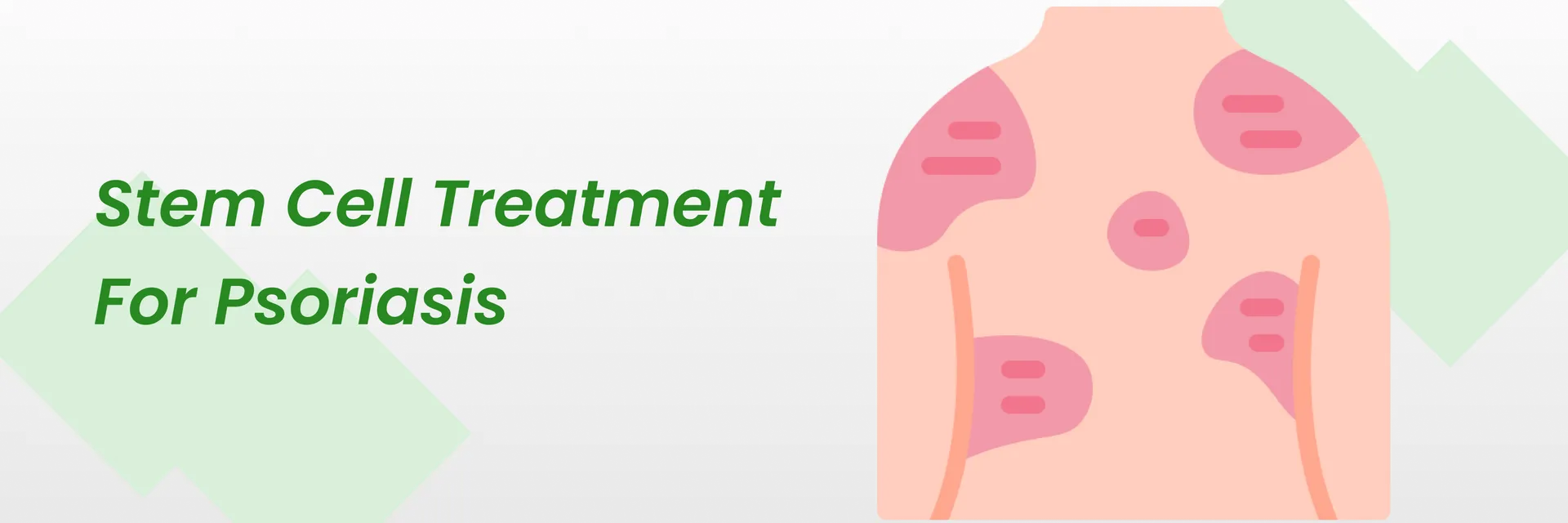 干細(xì)胞治療銀屑病2024（銀屑病患者的新希望）