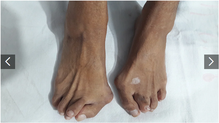 類風濕關節炎癥狀