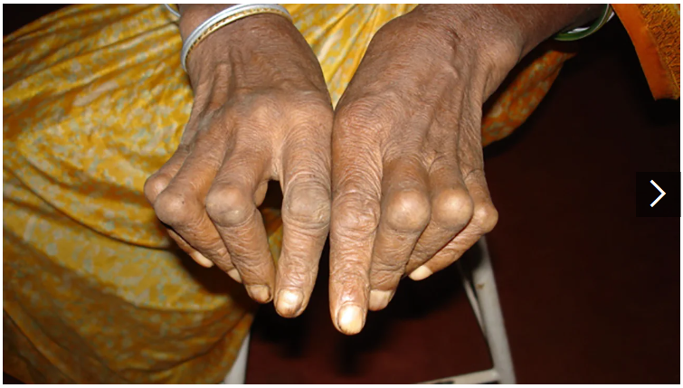 類風濕關節炎癥狀