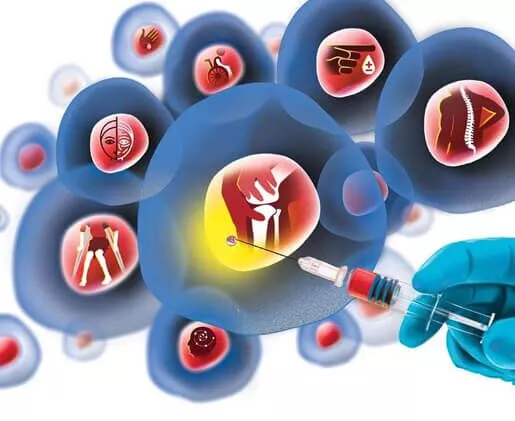 干細胞治療糖尿病的流程