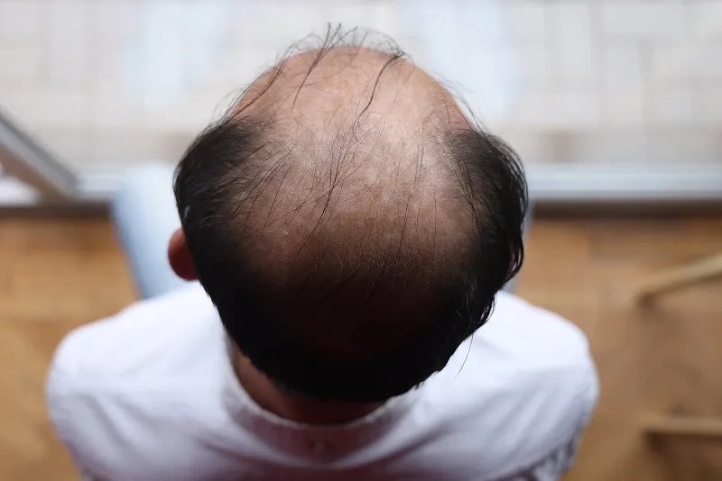 干細胞治療脫發(fā)的優(yōu)缺點 干細胞治療脫發(fā)的優(yōu)缺點