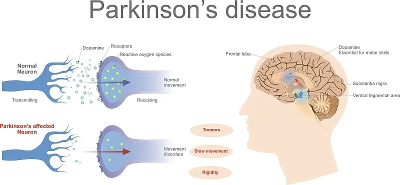 什么是帕金森病的再生醫(yī)學