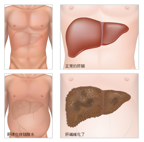干細(xì)胞移植作為中國人群肝硬化的輔助治療策略-：有效性和安全性的薈萃分析