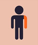 單癱型腦癱影響一側(cè)肢體，通常是手臂。