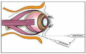6. 細胞后小管輸注 6. 細胞后小管輸注