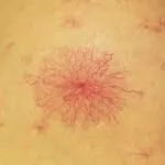 肝臟疾病警告標志蜘蛛狀血管瘤