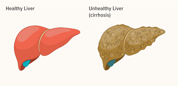 導(dǎo)致肝臟疾病的問題及其原因