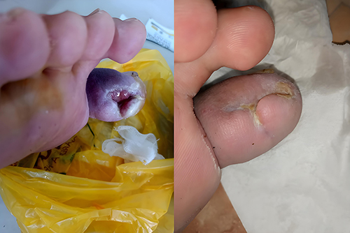 圖4：糖尿病潰瘍修復(fù)示例–干預(yù)前（左）和干預(yù)后（右）。