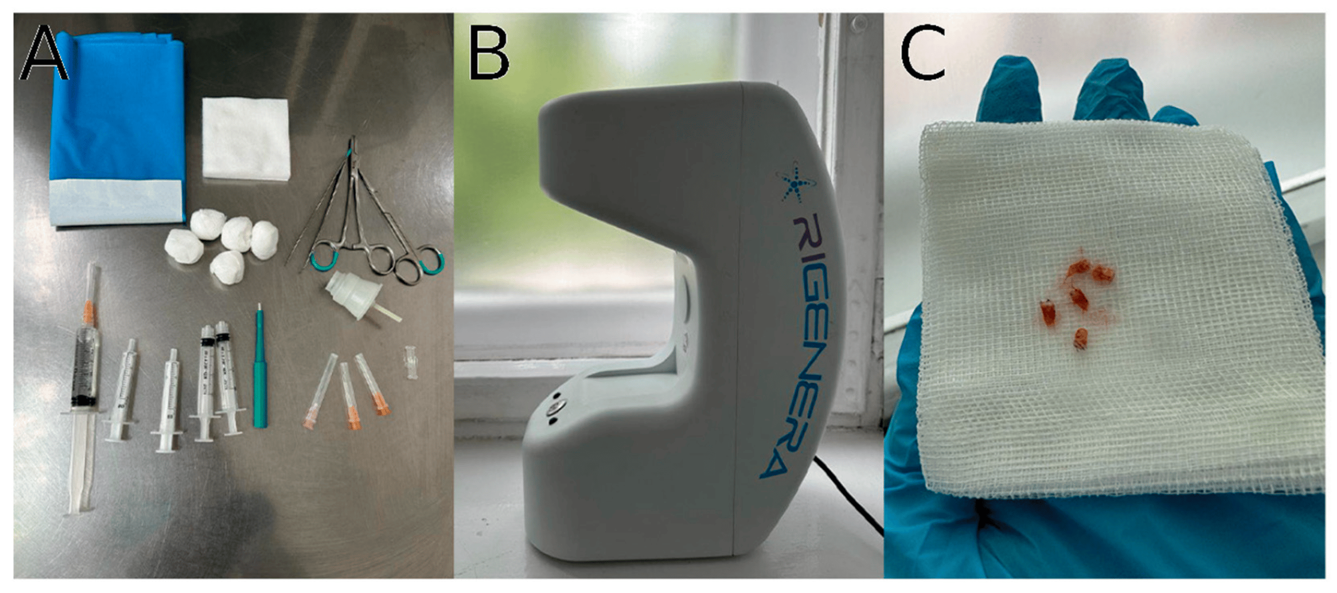 圖1：自體細胞微移植治療方案要素。