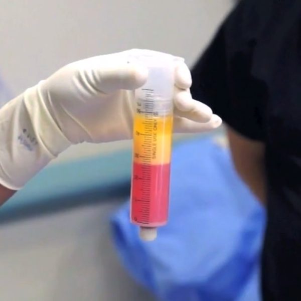 購買和使用低溫保存（冷凍）的臍帶干細胞是許多干細胞治療提供者的另一種流行選擇。