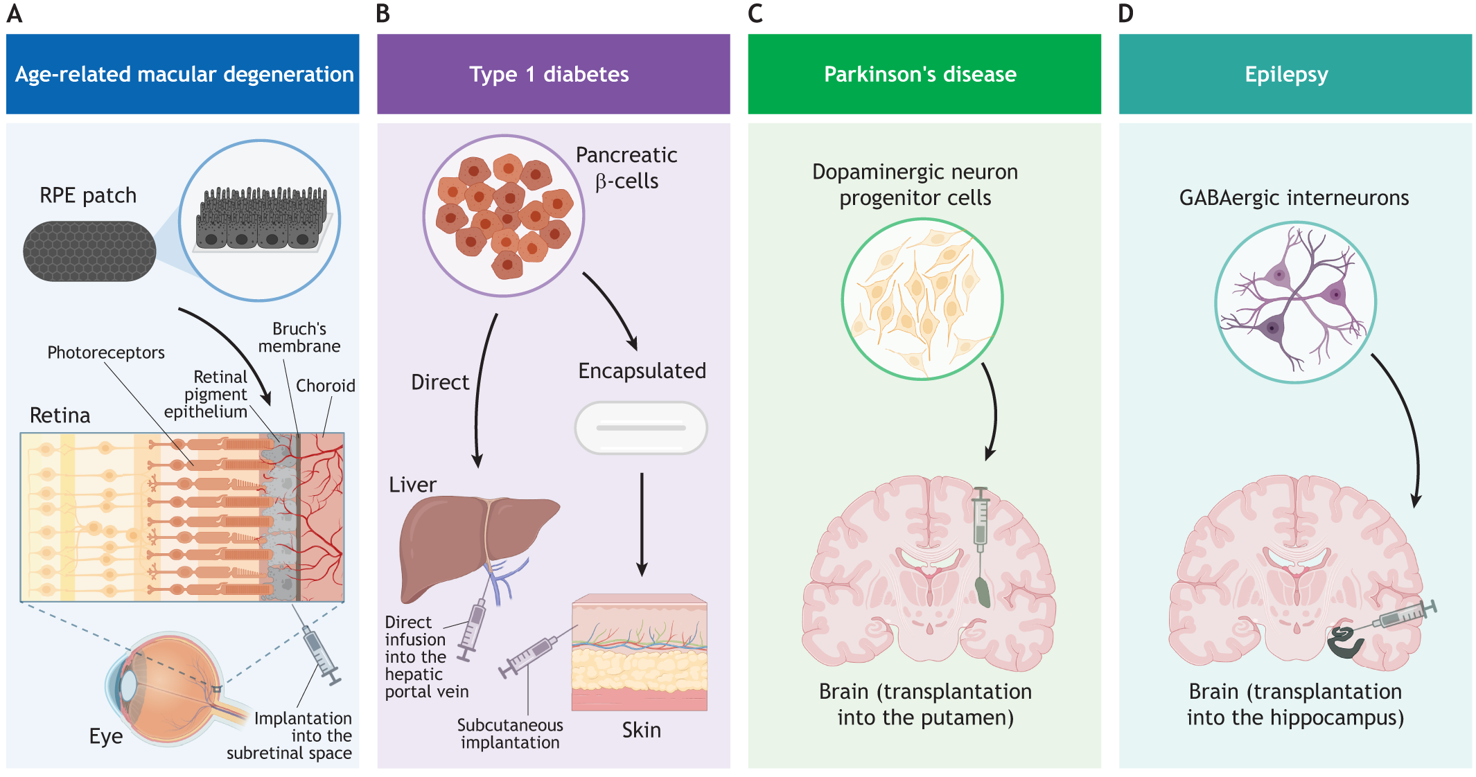 圖2：使用hPSC衍生細胞產品進行開創性臨床試驗時所涉及的細胞類型和注射部位的圖示。