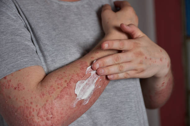 銀屑病的4類治療方式和用藥類型，你都清楚嗎？