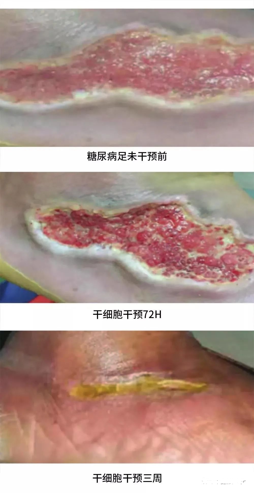 患者治療72小時化膿性分泌物和傷口大小明顯減少，3周后足部潰瘍幾乎愈合，足部行走功能也得到了恢復。