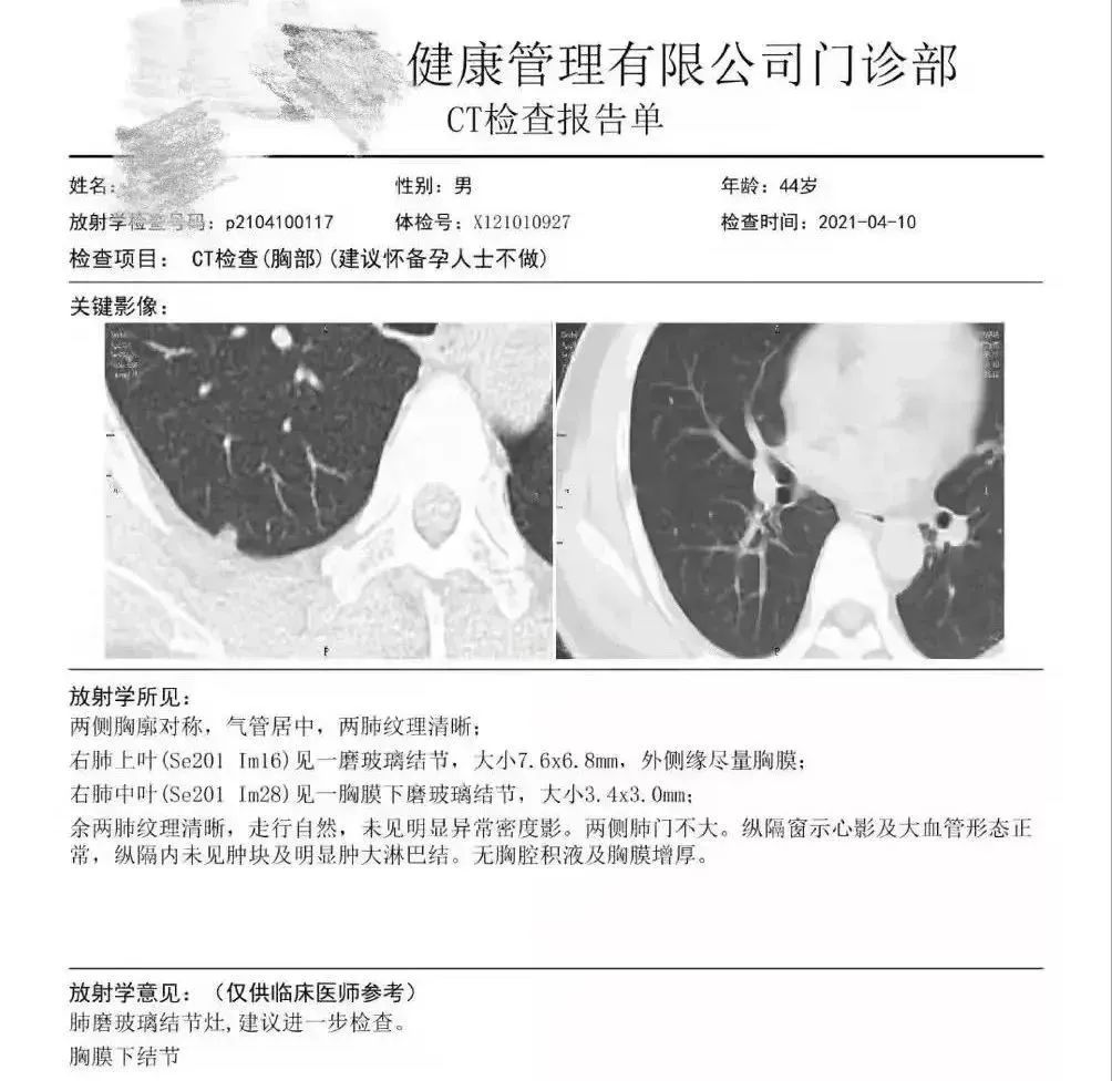 結果發現王先生右肺胸膜表面下（肺的內部），存在兩枚磨玻璃結節，其中較大者直徑7.6mm。