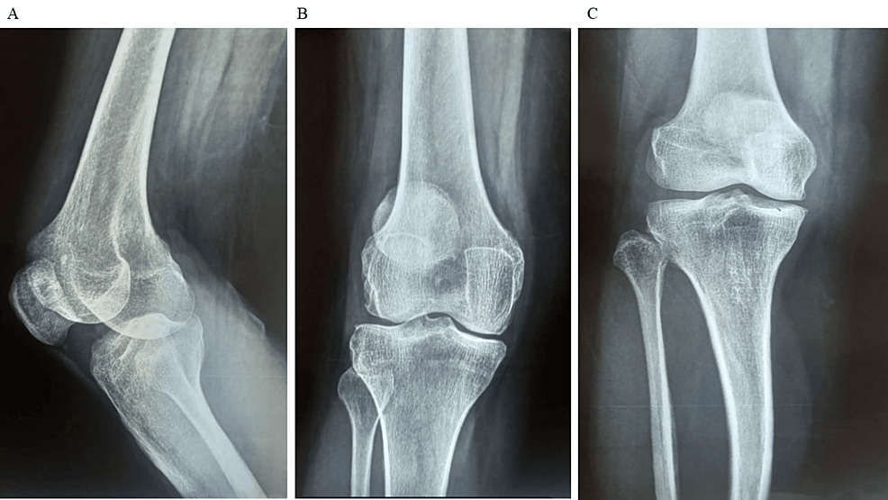 圖1：顯示了開始干細胞治療之前的骨骼側視圖和前后視圖。