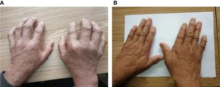 一名68歲男性被診斷患有類風(fēng)濕性關(guān)節(jié)炎治療前后的對比 