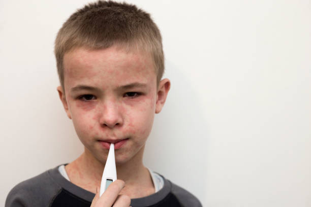 兒童狼瘡性腎炎-癥狀、原因和治療方法