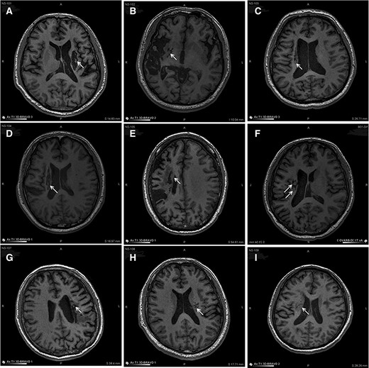 圖3：NSI-566移植后最新隨訪時梗塞部位的MRI。