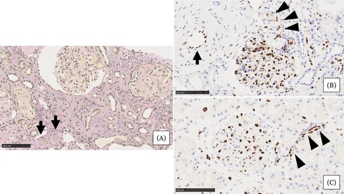 在住院第31天進行的腎活檢結(jié)果