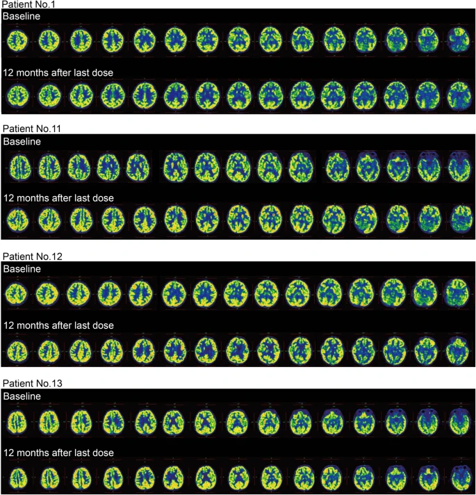 圖3：干預后腦代謝變化。