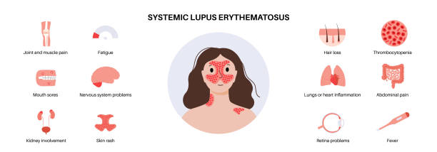 紅斑狼瘡會對患者壽命造成影響嗎？