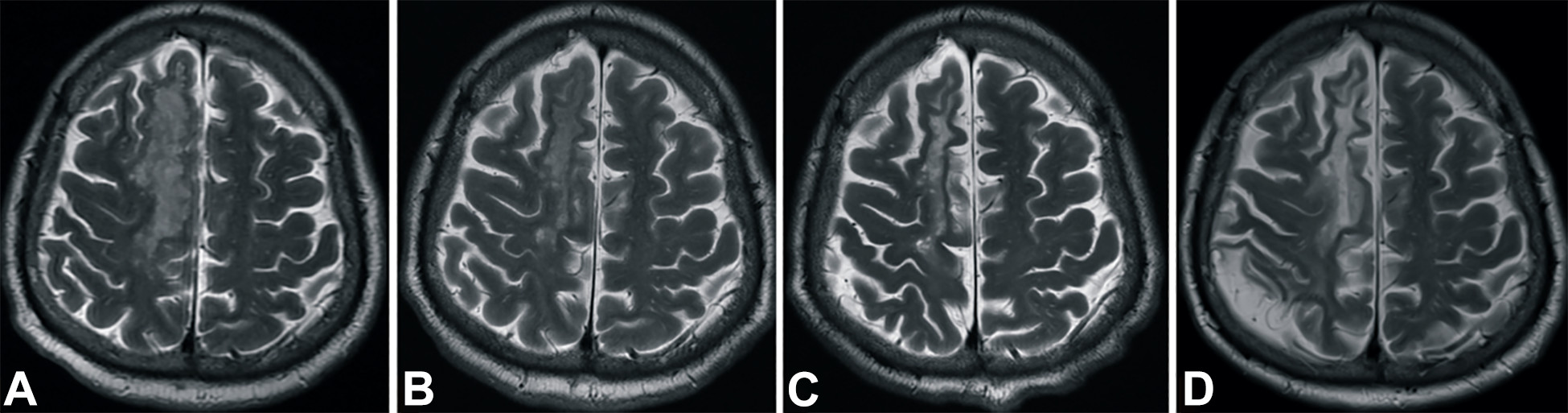 中風后2小時和輸血后6個月獲得的T2加權圖像。