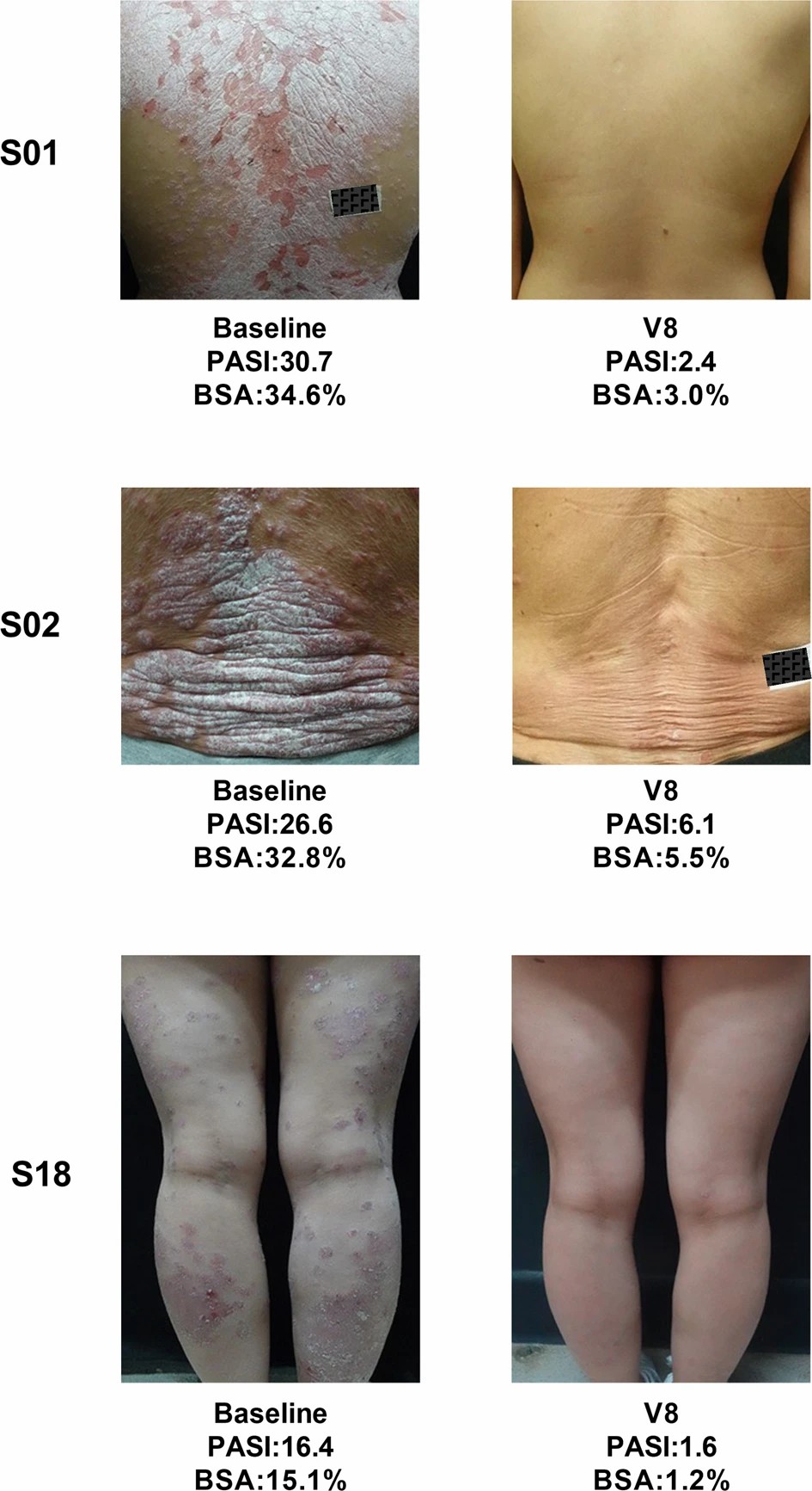 三名患者經過治療后根據 PGA 評分顯示無疾病跡象（評分為 0）或輕微疾?。ㄔu分為 1）。