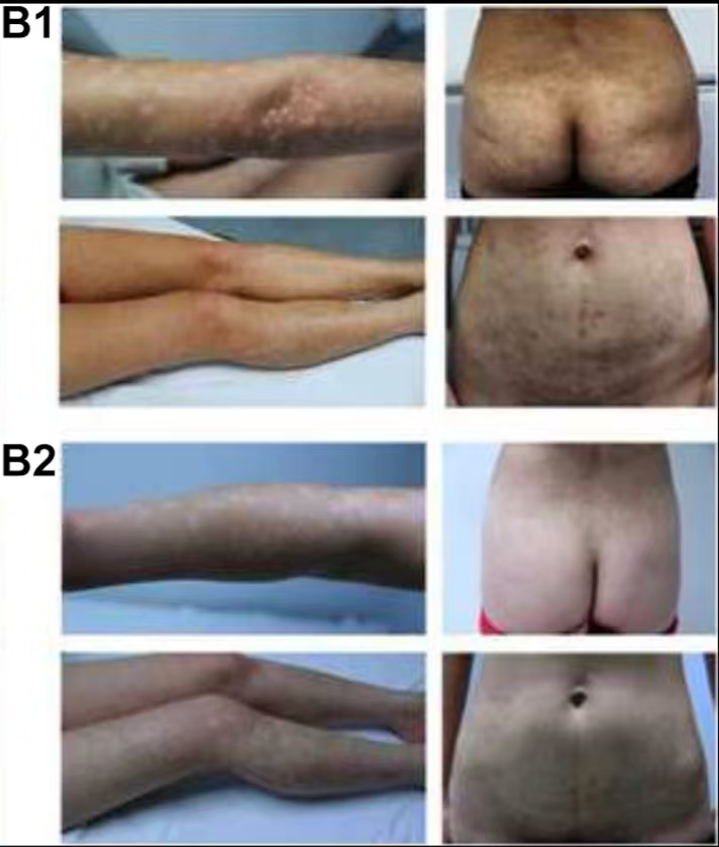 （圖B1）患者入院后體檢發現，患者全身遍布橙紅色斑塊，上面覆有銀色鱗屑

（圖B2）治療初期，我院給予患者3次臍帶間充質干細胞，連續3周回輸，患者全身表面逐漸恢復光滑