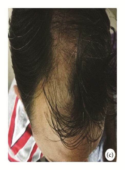 局部應用骨髓間充質干細胞一個月后，銀屑病消退，炎性紅斑完全清除（c）。