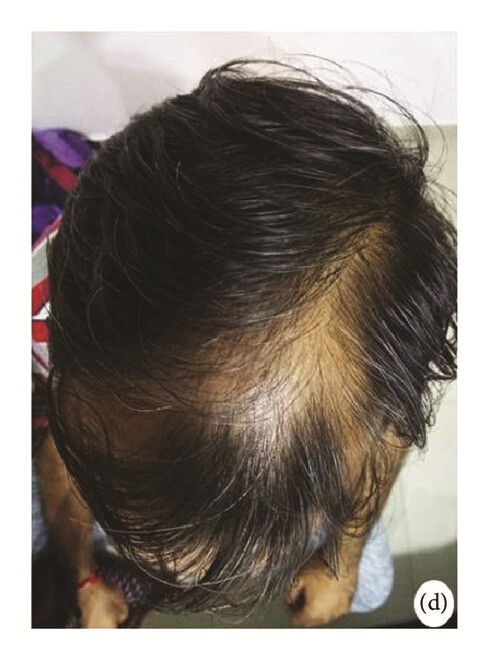 局部應用骨髓間充質干細胞一個月后，銀屑病消退，炎性紅斑完全清除（d）。