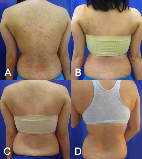 (圖2A）基線（細胞移植前)；(圖2B）首次輸注后 30 天；(圖C2) 121 天后；(圖2D）231 天后。