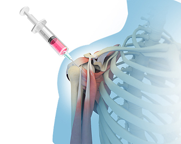 間充質(zhì)干細胞需要注射幾次才會有效果?