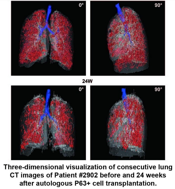 患者#2902在自體P63+細胞移植前后24周連續肺部CT圖像的三維可視化。