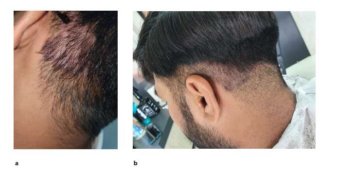 圖2.患者枕部頭皮銀屑病治療后圖像2周(a)和4周(b)頭皮銀屑病治療后鱗屑和斑塊減少的隨訪圖像。