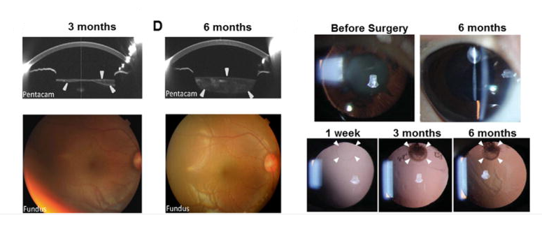手術(shù)后六個月,囊袋充滿了再生晶狀體組織 手術(shù)后六個月,囊袋充滿了再生晶狀體組織