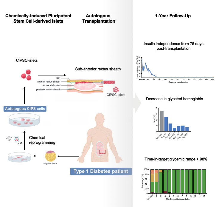 圖2：SLE患者接受CAR-T細(xì)胞治療的程序和結(jié)果。