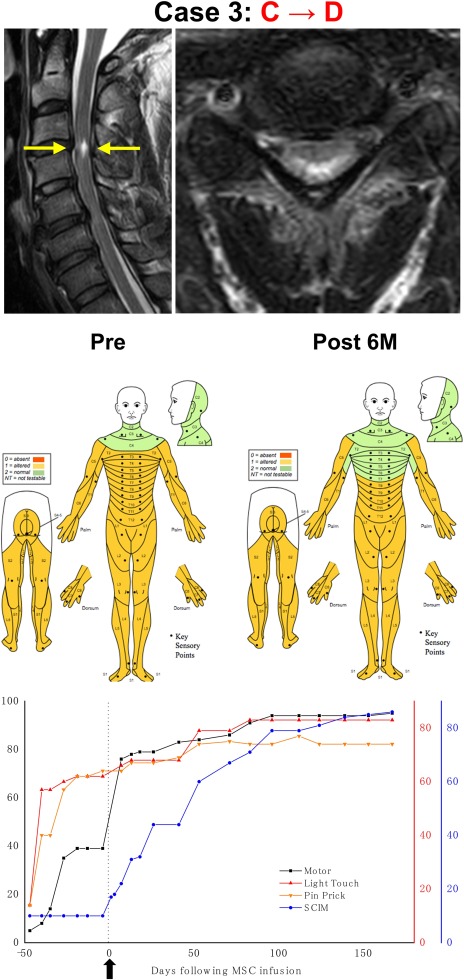 干細胞治療后患者的恢復狀態圖