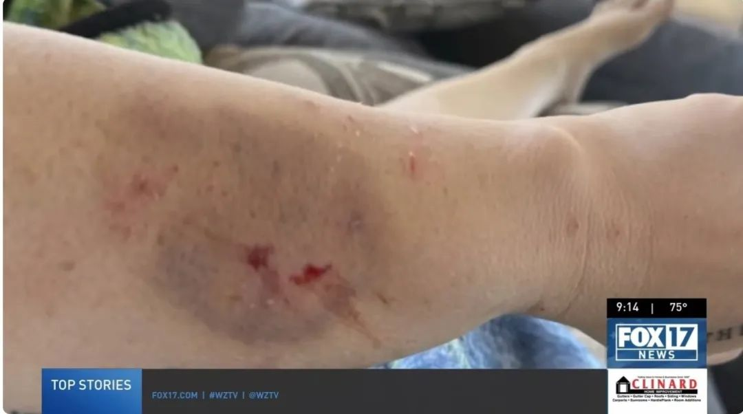 在接受干細胞治療前表現出嚴重的自閉癥癥狀，甚至曾咬傷母親安吉拉，留下了永久的疤痕