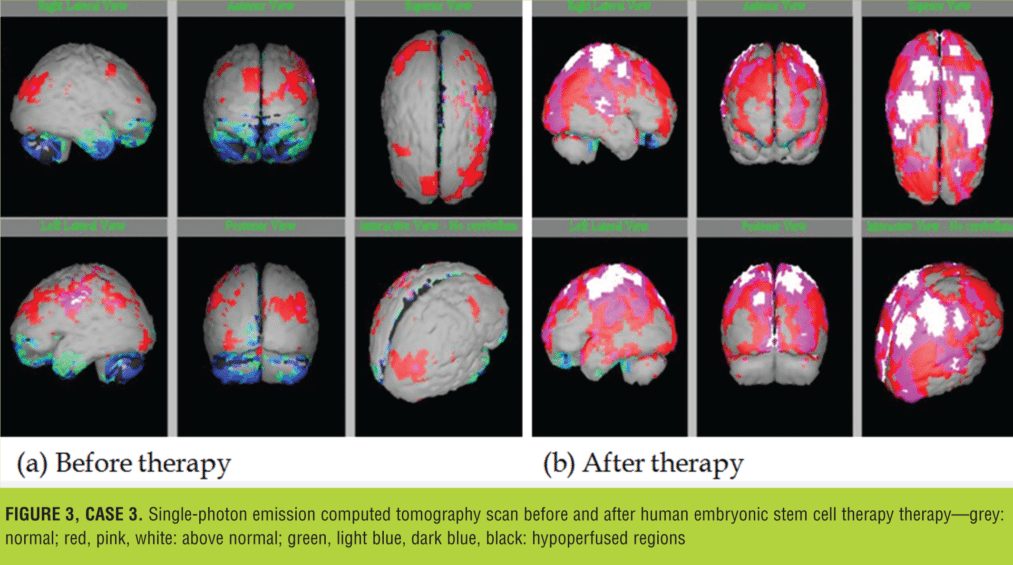 與之前的掃描結果相比，2014 年 1 月 9 日的 SPECT 掃描顯示腦灌注流正常（圖 3）