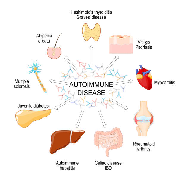 間充質干細胞療法：一種在10種自身免疫性疾病中有前景的治療方法